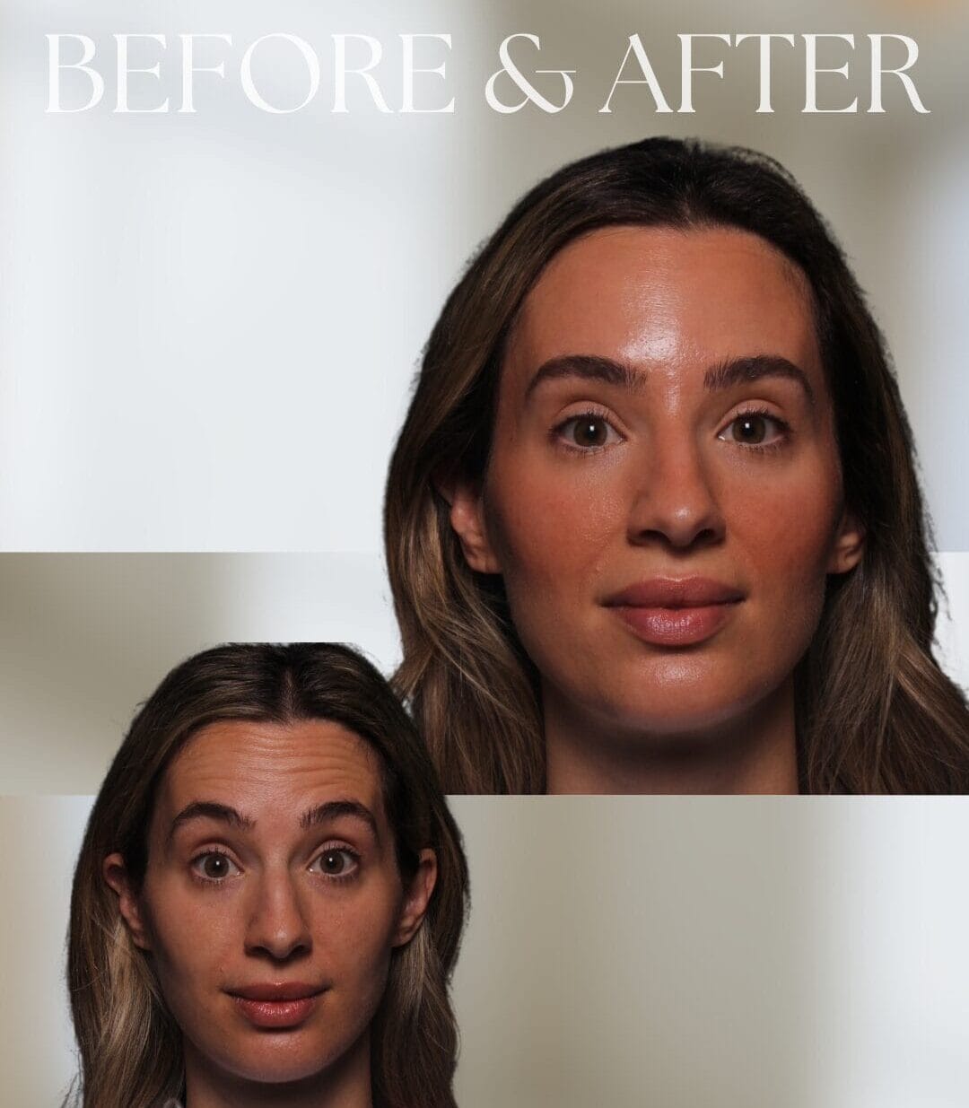 Before and after photo of a neuromodulator treatment.